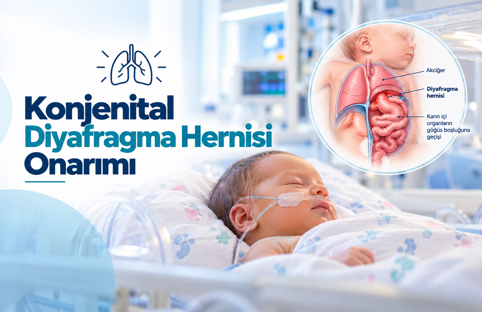 Yenidoğanlarda Konjenital Diyafragma Hernisi Nedir?